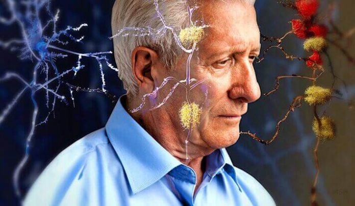 Alzheimer, la predisposizione inizia già da bambini. Le cause nell’articolo.